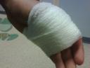 Gabriels hand bandaged