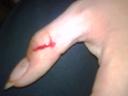 Gabriels sliced thumb